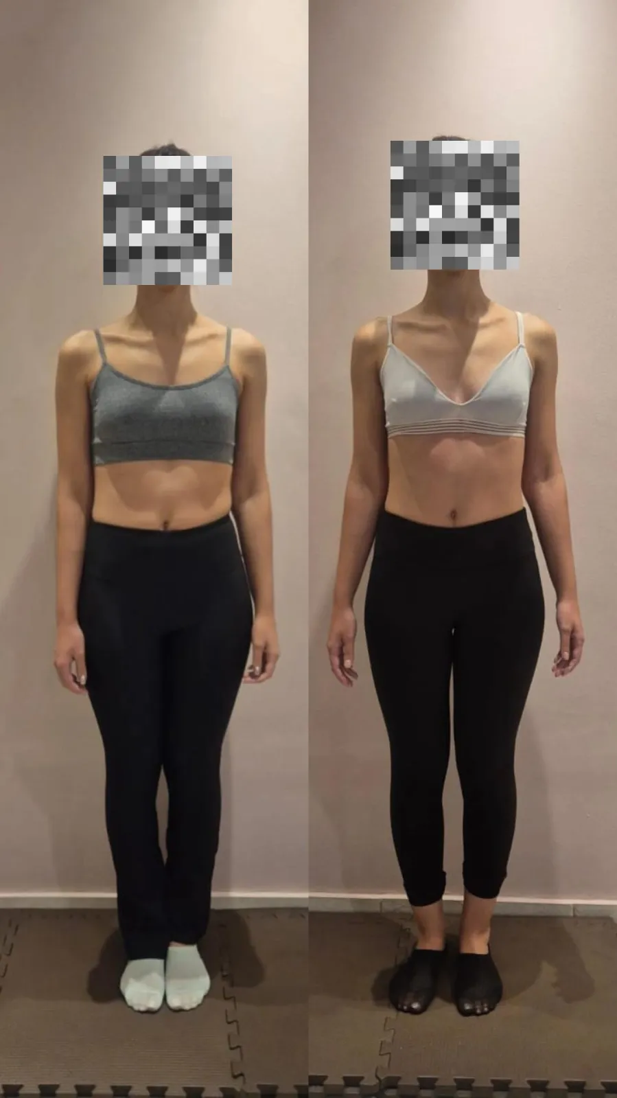 Paciente A.M. - comparativo frontal antes e depois do tratamento na Benevento Fisioterapia
