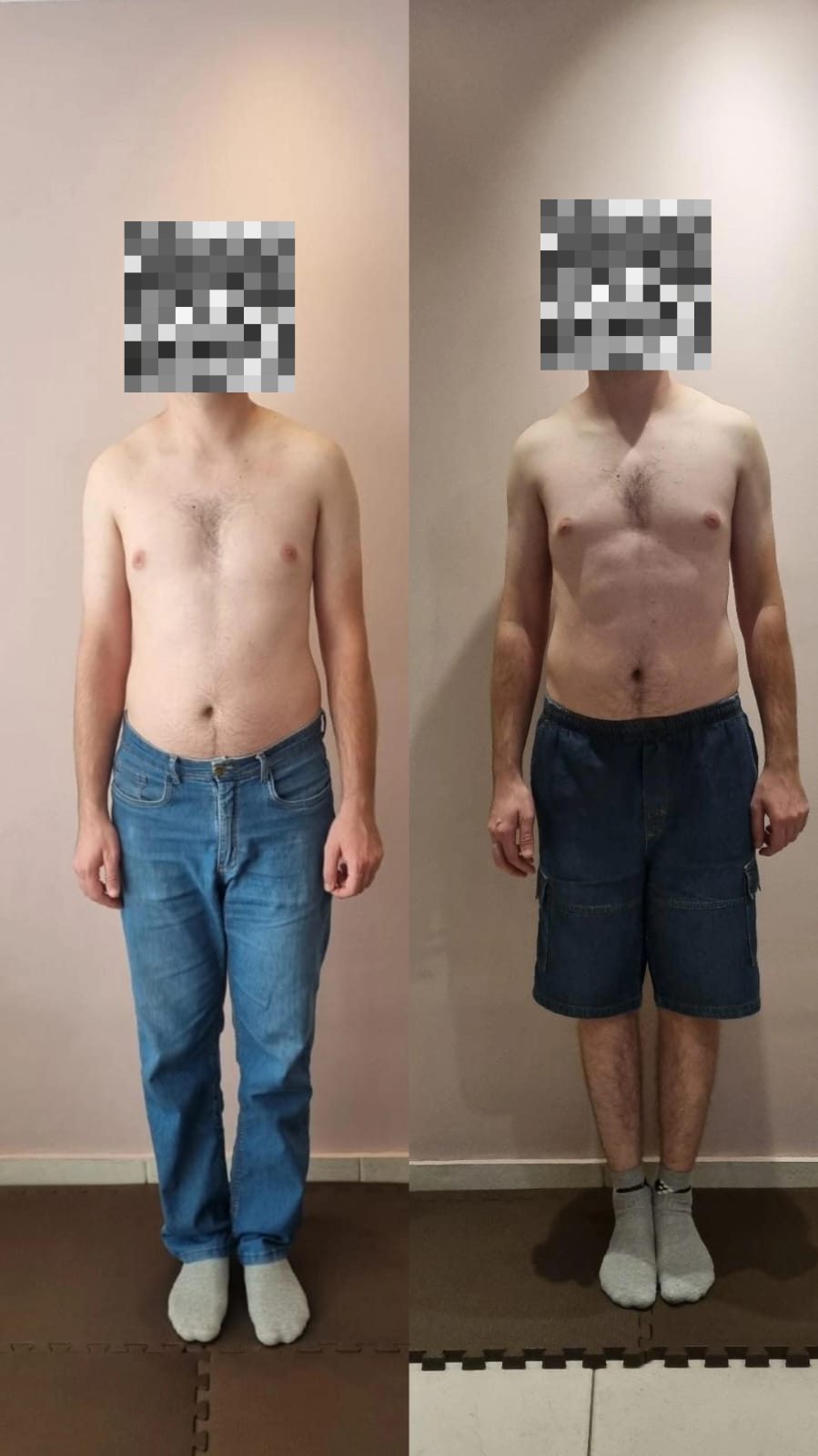 Paciente R.S. - comparativo frontal antes e depois do tratamento na Benevento Fisioterapia